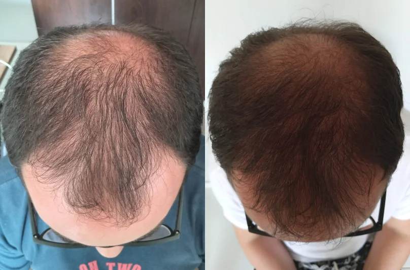 Antes e Depois 5