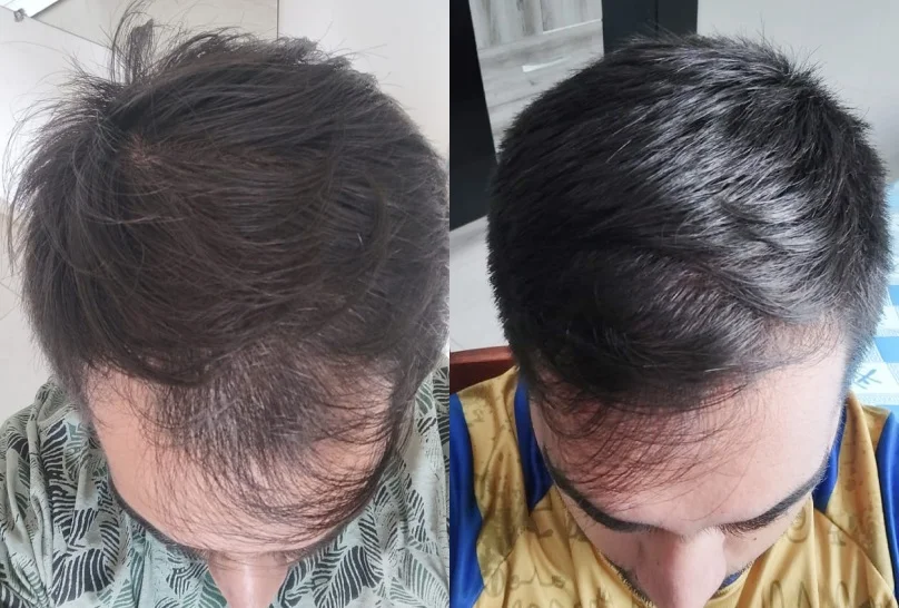 Antes e Depois 6